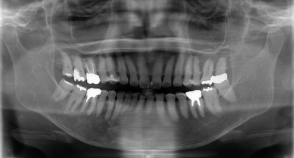 親知らずを抜歯しなくてもいいケース