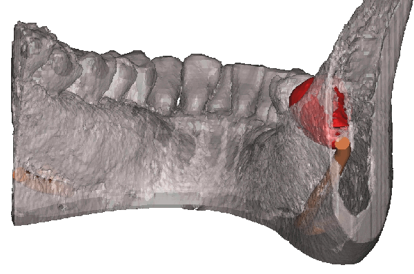 親知らずを抜歯した方がいいケース1