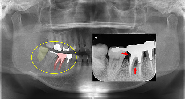 親知らずを移植したケース