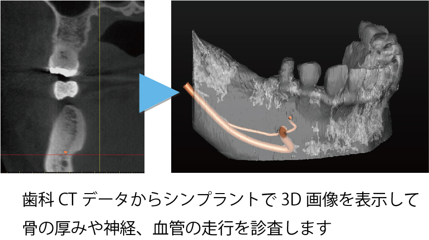 シンプラント プロとは 画像その1