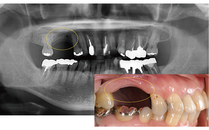 骨が足りない場合は 画像その4
