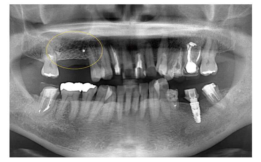 骨が足りない場合は 画像その5