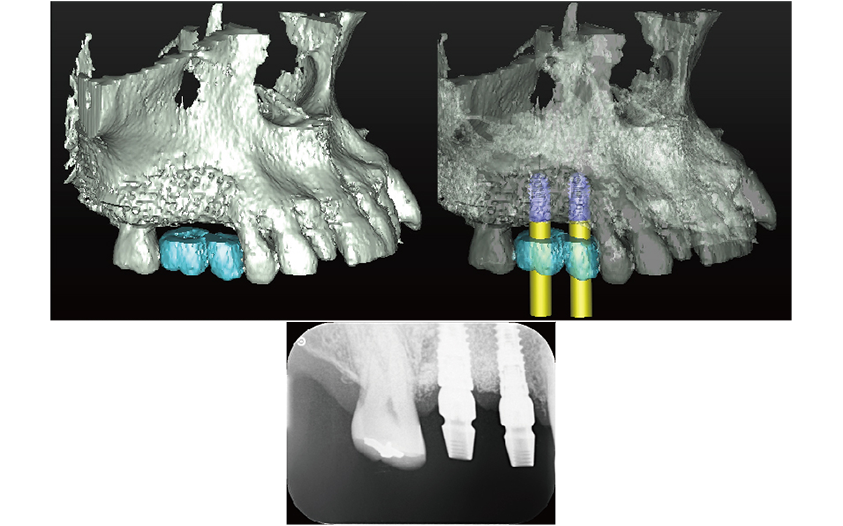 骨が足りない場合は 画像その6