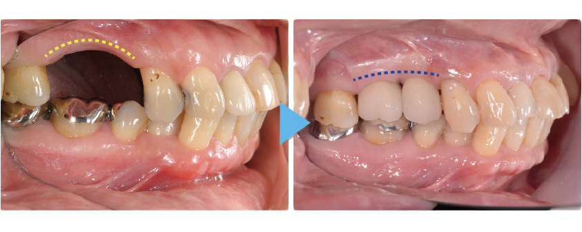 骨が足りない場合は 画像その7