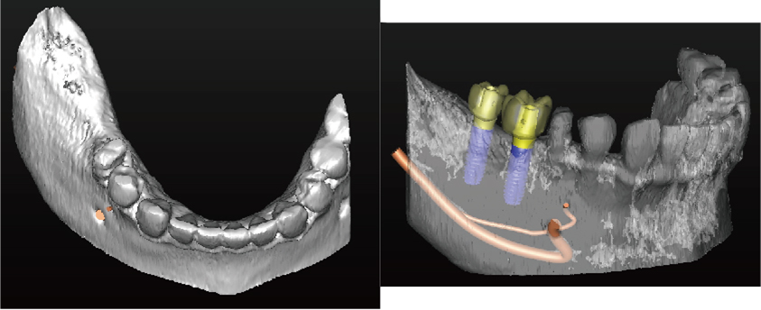 シンプラント プロとは 画像その2