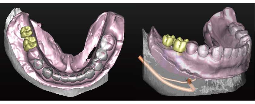 シンプラント プロとは 画像その3