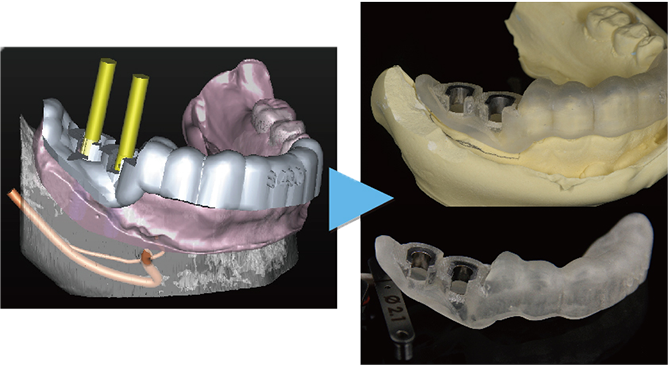 コンピューターガイデッド インプラント治療 画像その1