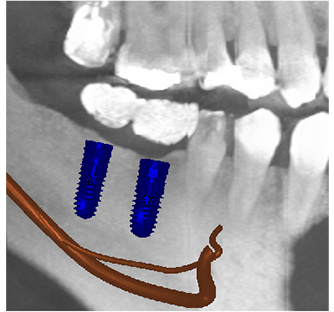 コンピューターガイデッド インプラント治療 画像その2