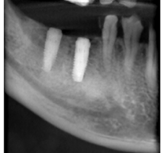 コンピューターガイデッド インプラント治療 画像その2