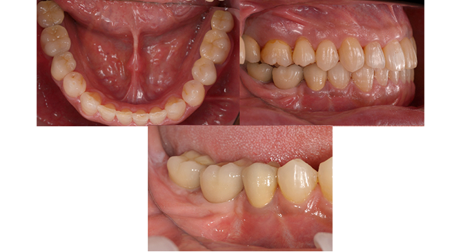 コンピューターガイデッド インプラント治療 画像その3