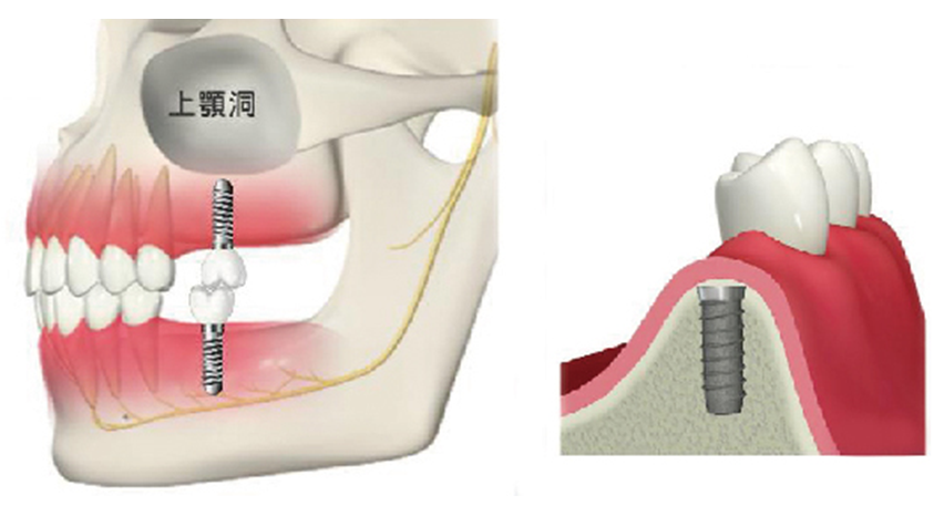 骨が足りない場合は 画像その1
