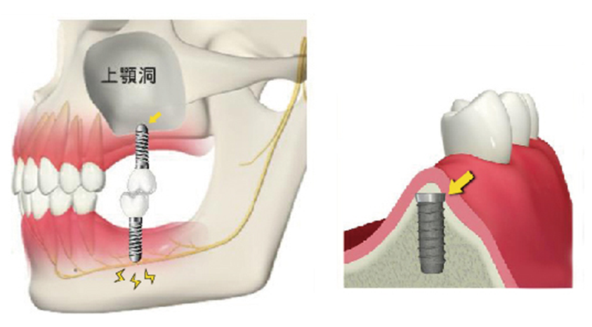 骨が足りない場合は 画像その2