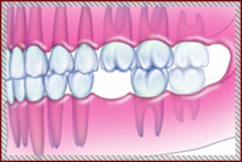 歯が抜けてしまった方へ 画像その1