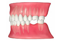 歯が抜けてしまった方へ 画像その1