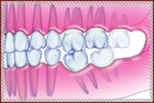 歯が抜けてしまった方へ 画像その2