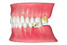 歯が抜けてしまった方へ 画像その2