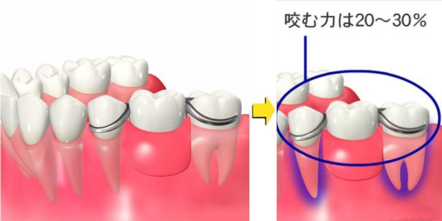 歯が抜けてしまった方へ 画像その3