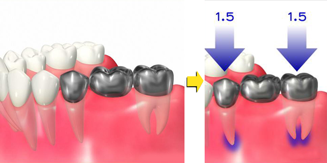 歯が抜けてしまった方へ 画像その4