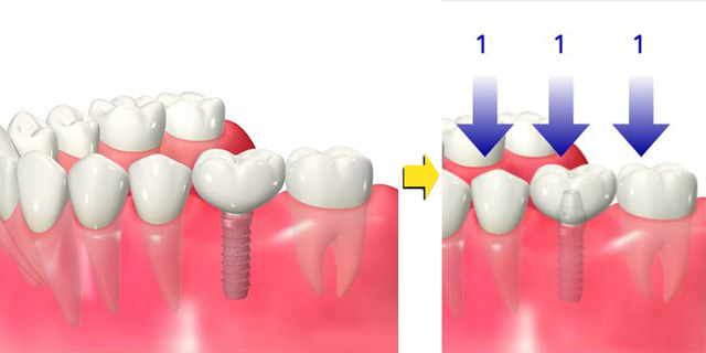 歯が抜けてしまった方へ 画像その5